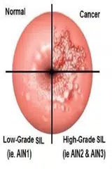 Anal cancer APK download