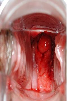 Fast growing vaginal tumor