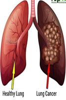 Cancer du poumon Affiche