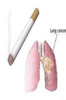 Lung cancer اسکرین شاٹ 1