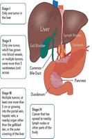 Cáncer de hígado captura de pantalla 1