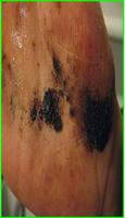 Skin Cancer ภาพหน้าจอ 1