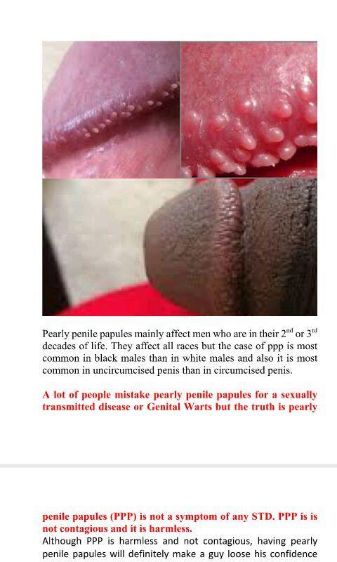 Penile papules are what 3 Ways