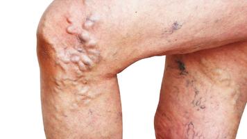 home remedies for varicose veins in testicles اسکرین شاٹ 3