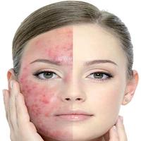 Get Rid of Acne اسکرین شاٹ 1