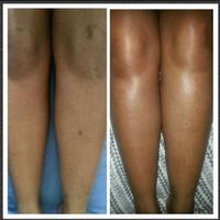 How to bleach your knee  (Guid screenshot 1
