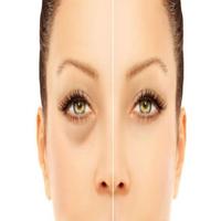 how to remove dark circles  (G Plakat