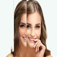 How to get ride of Freckles Plakat