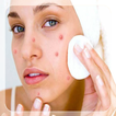 Get Rid of Acne (Guide)