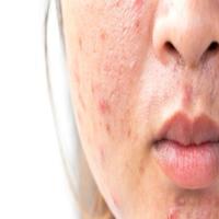 Get Rid of Acne bài đăng