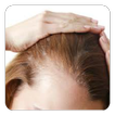 Baldness Guide