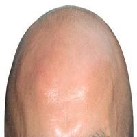 Baldness bài đăng