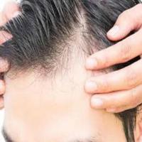 Baldness ảnh chụp màn hình 1
