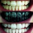Teeth whitening (Guide)