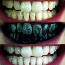 Teeth whitening (Guide) APK