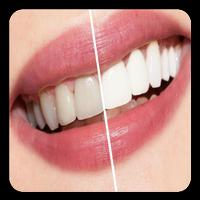 Teeth whitening (Guide) Cartaz