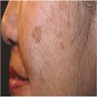 Age Spots اسکرین شاٹ 1