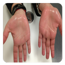 Sweaty Palms and Feet (Guide) APK