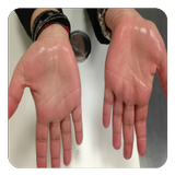 Sweaty Palms and Feet biểu tượng