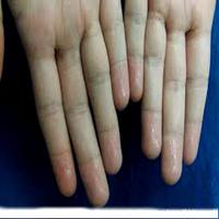 Sweaty Palms and Feet ảnh chụp màn hình 1