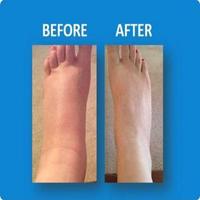 Swollen Feet постер