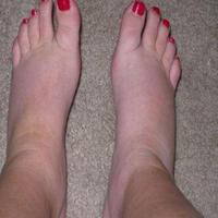 Swollen Feet скриншот 1