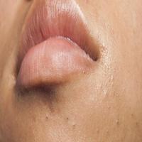 Blackheads bài đăng