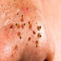 Blackheads ảnh chụp màn hình 1