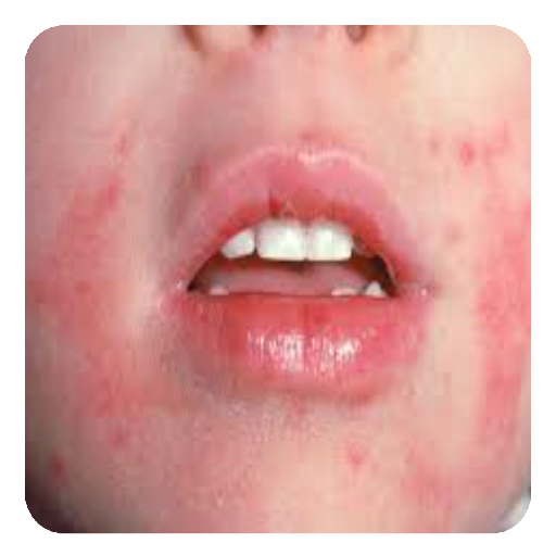 Eczema in Children Guide