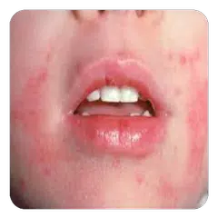 Eczema in Children Guide APK 下載