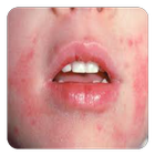 Eczema in Children biểu tượng