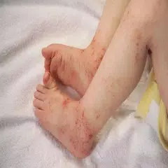Eczema in Children Guide APK download