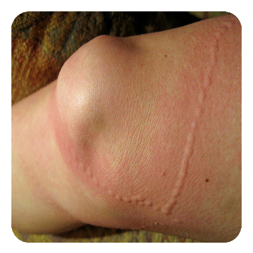 Jellyfish Stings (Guide)