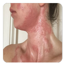 Allergic Reactions Home Remedy APK