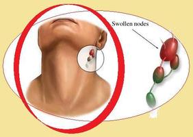 Tonsillitis infection 截圖 1