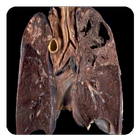 tuberculosis icon