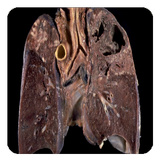 tuberculosis icône