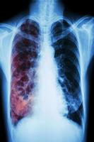 tuberculosis پوسٹر