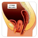 Uterine Prolapse APK