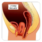 Uterine Prolapse biểu tượng
