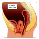 Icona Uterine Prolapse