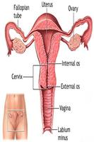 Uterine Prolapse capture d'écran 1