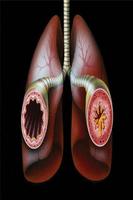 Asthma-poster
