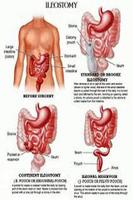 Ileostomy پوسٹر