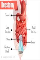 Ileostomy اسکرین شاٹ 1