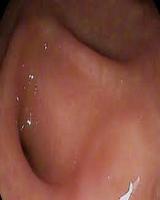 Coloscopy اسکرین شاٹ 1
