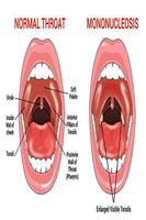 Mononucleosis poster