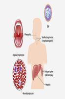 Mononucleosis capture d'écran 1