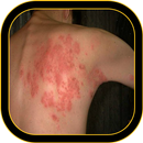 Shingles APK