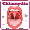 Chlamydia Dalam Tenggorokan